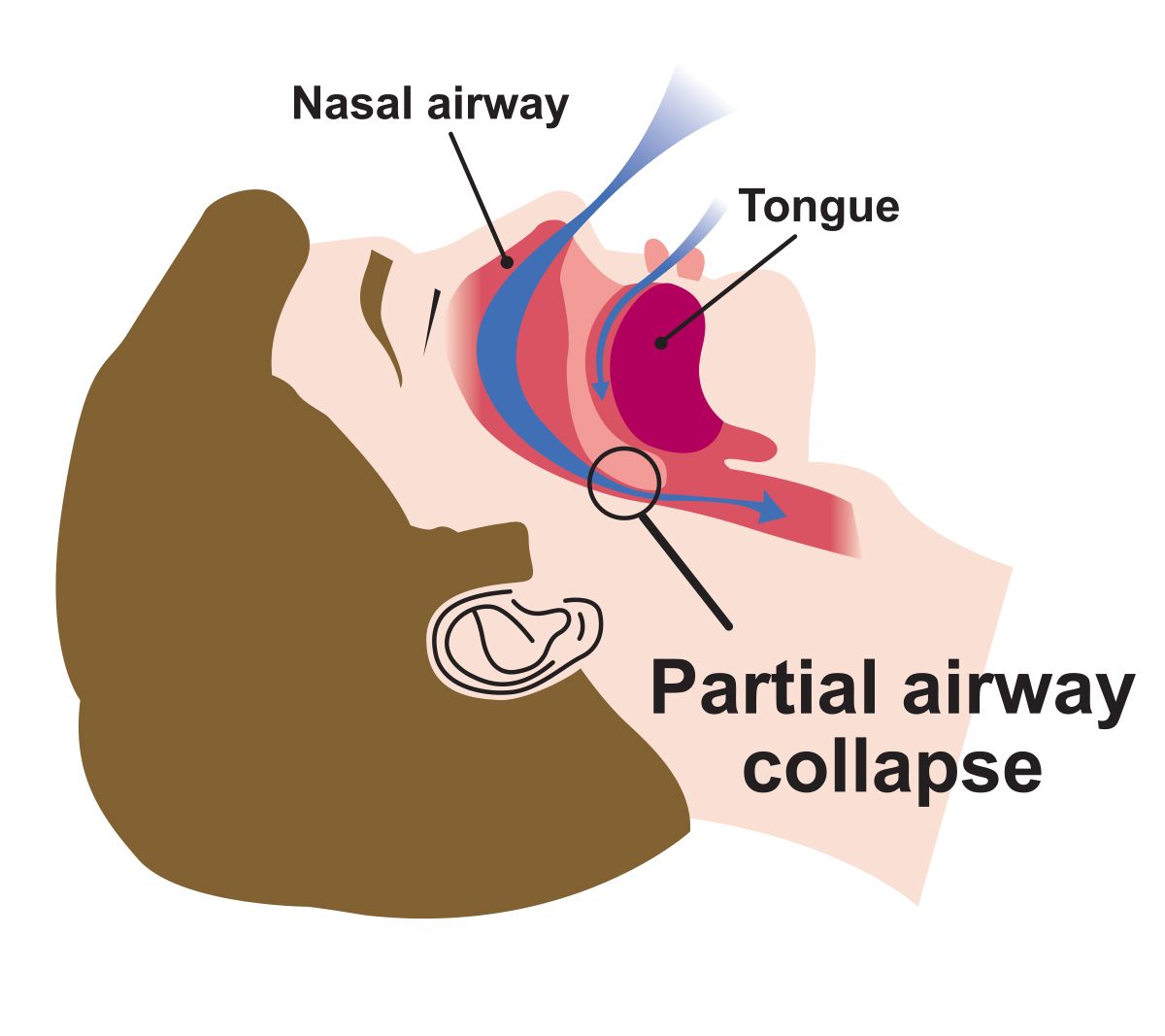 Snring Due to Partial Airway Collapse