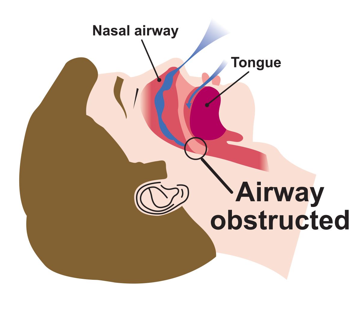 Obstructed Airway