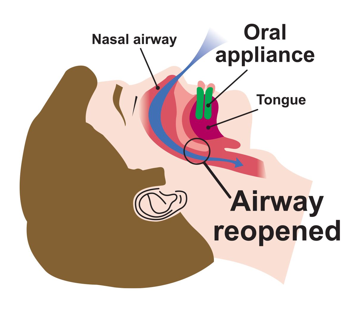 Oral Appliance opening airway