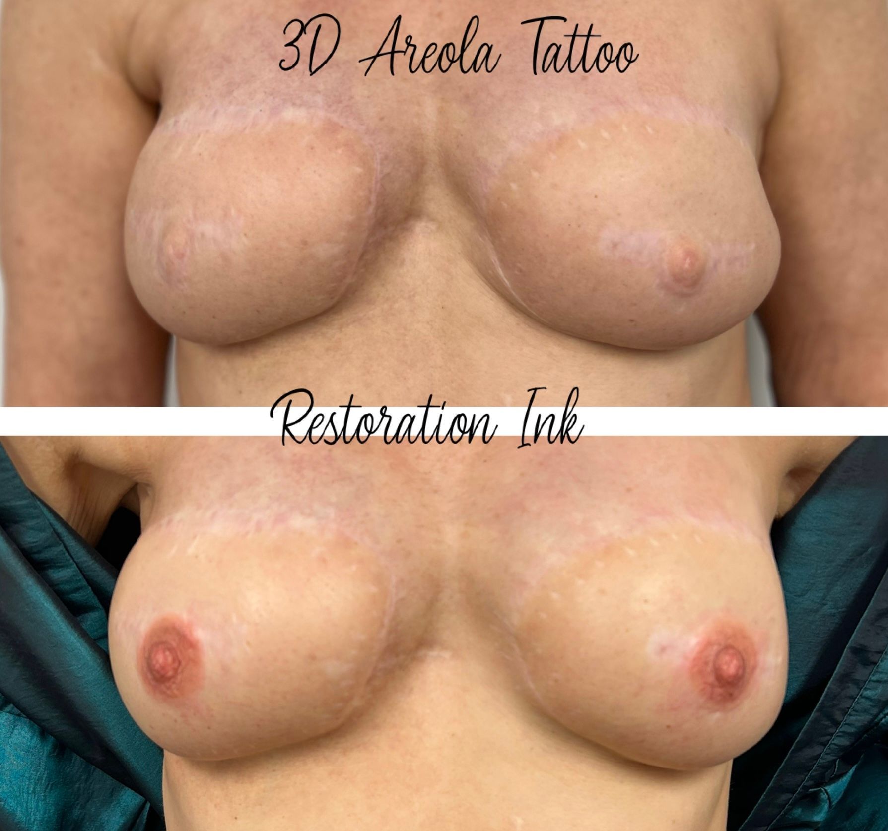 Natural-looking areola restoration result at Restoration Ink in Albuquerque, NM