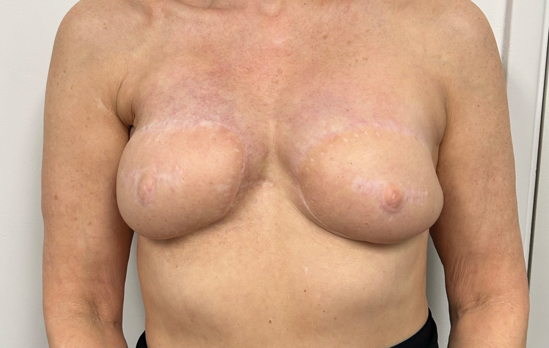 3D areola tattoo before and after