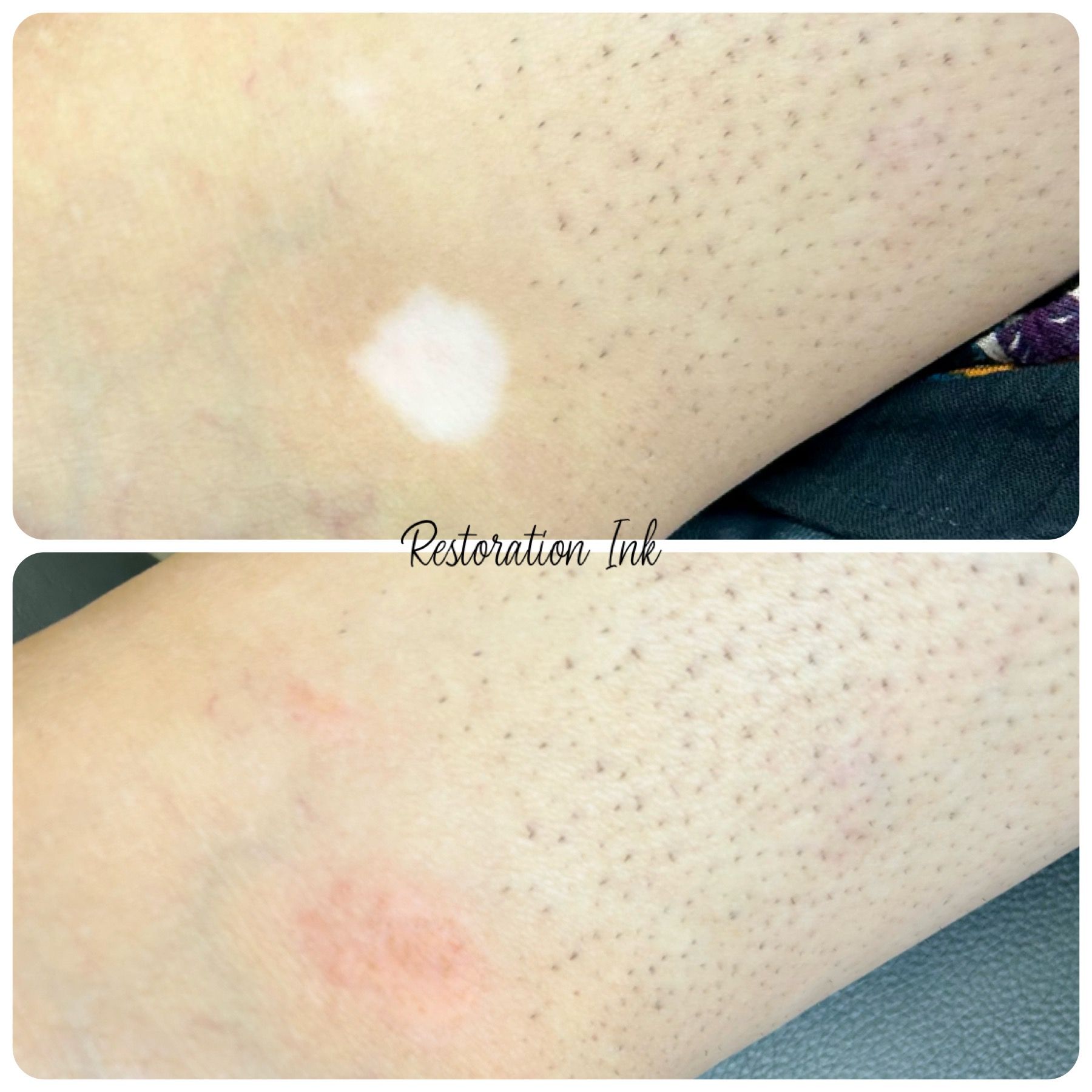 Vitiligo treatment with camouflage ink 