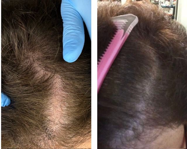 Scalp Micropigmentation treatment to create the illusion of density for hair loss