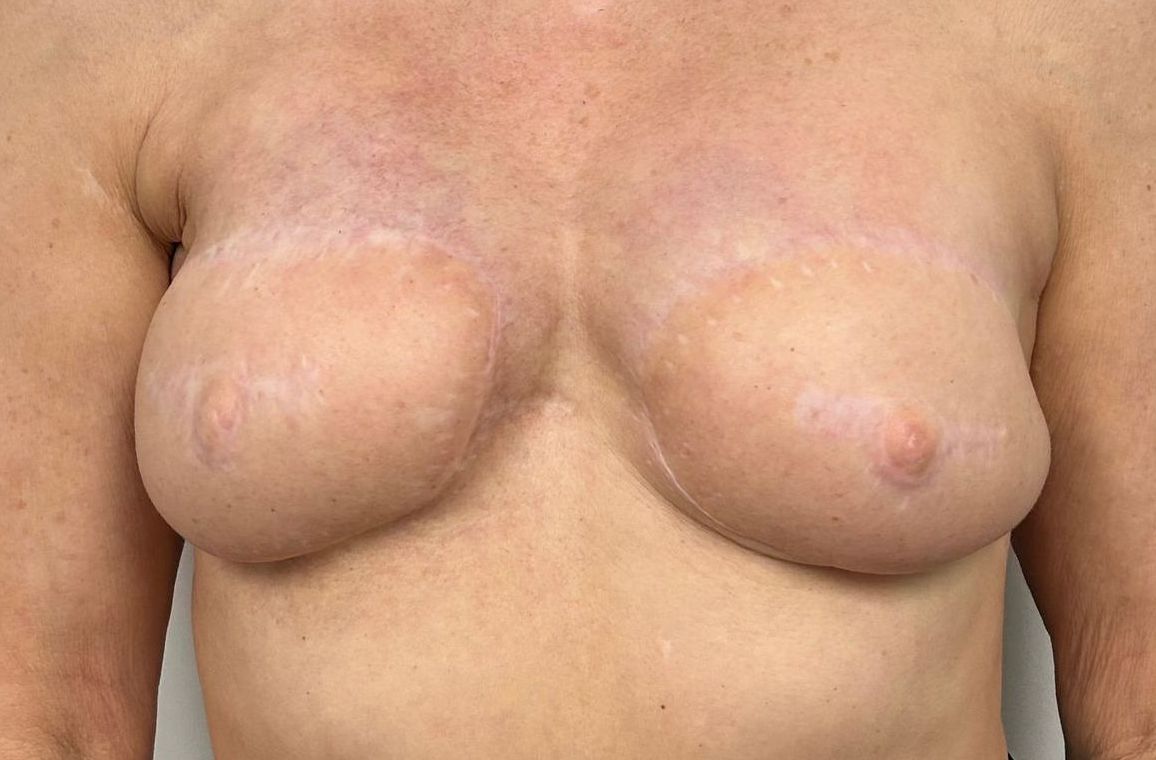 3D areola tattoo before and after near me, nipple tattoos in Albuquerque, NM