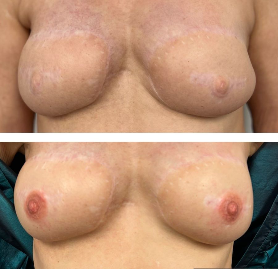 3D areola tattoos Albuquerque 