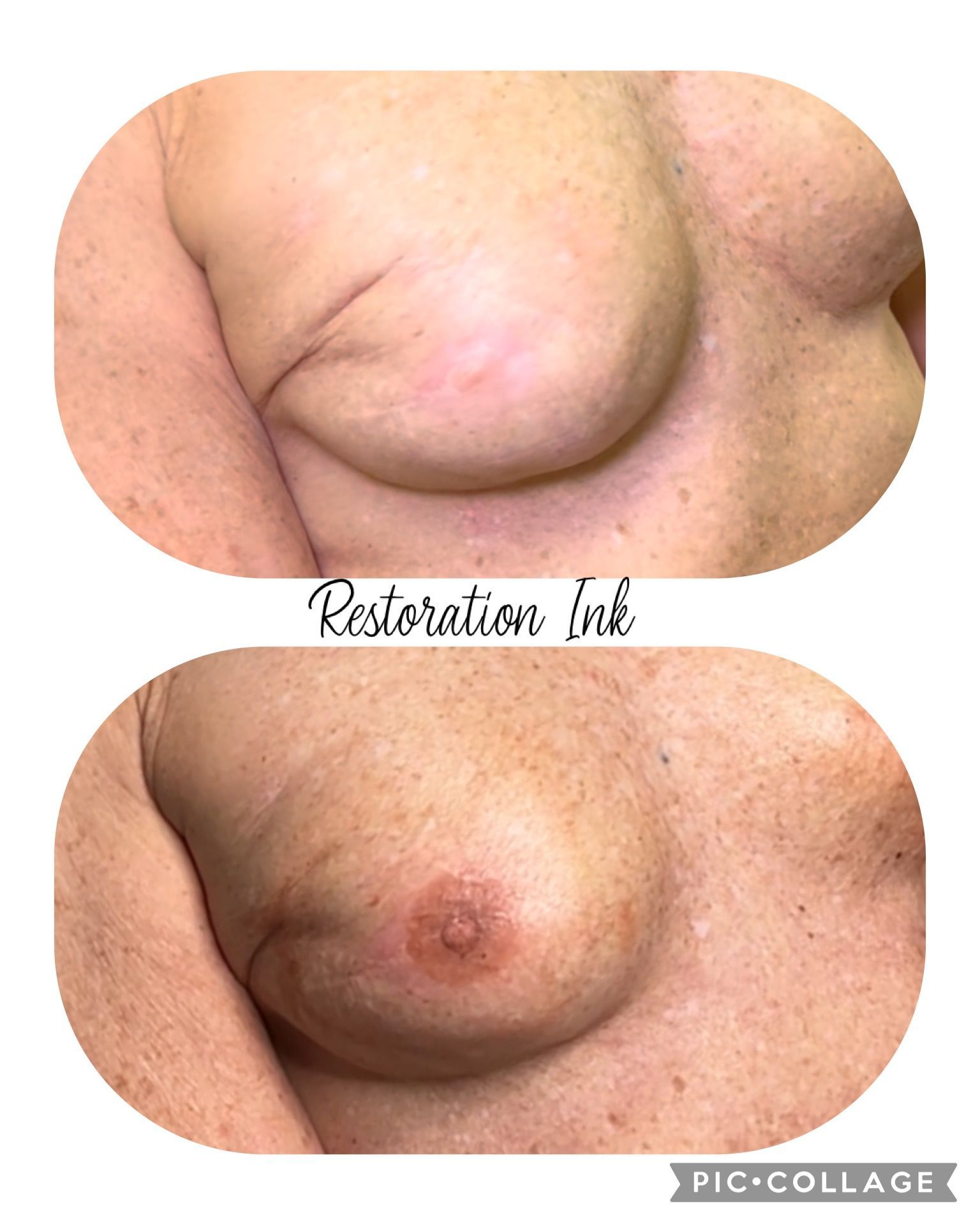 Before and after 3D areola tattoo result for post-mastectomy client.