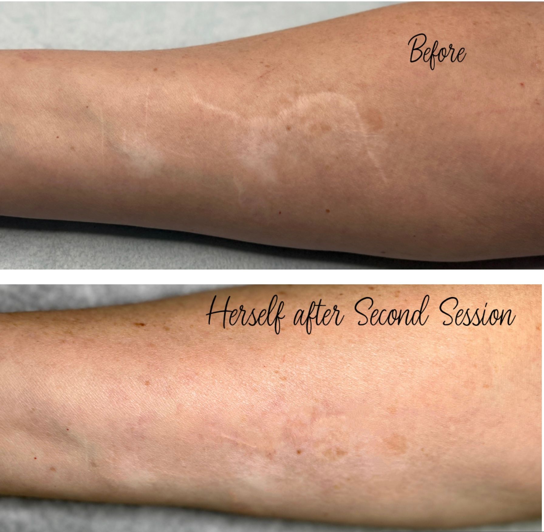 scar camouflage near me before and after