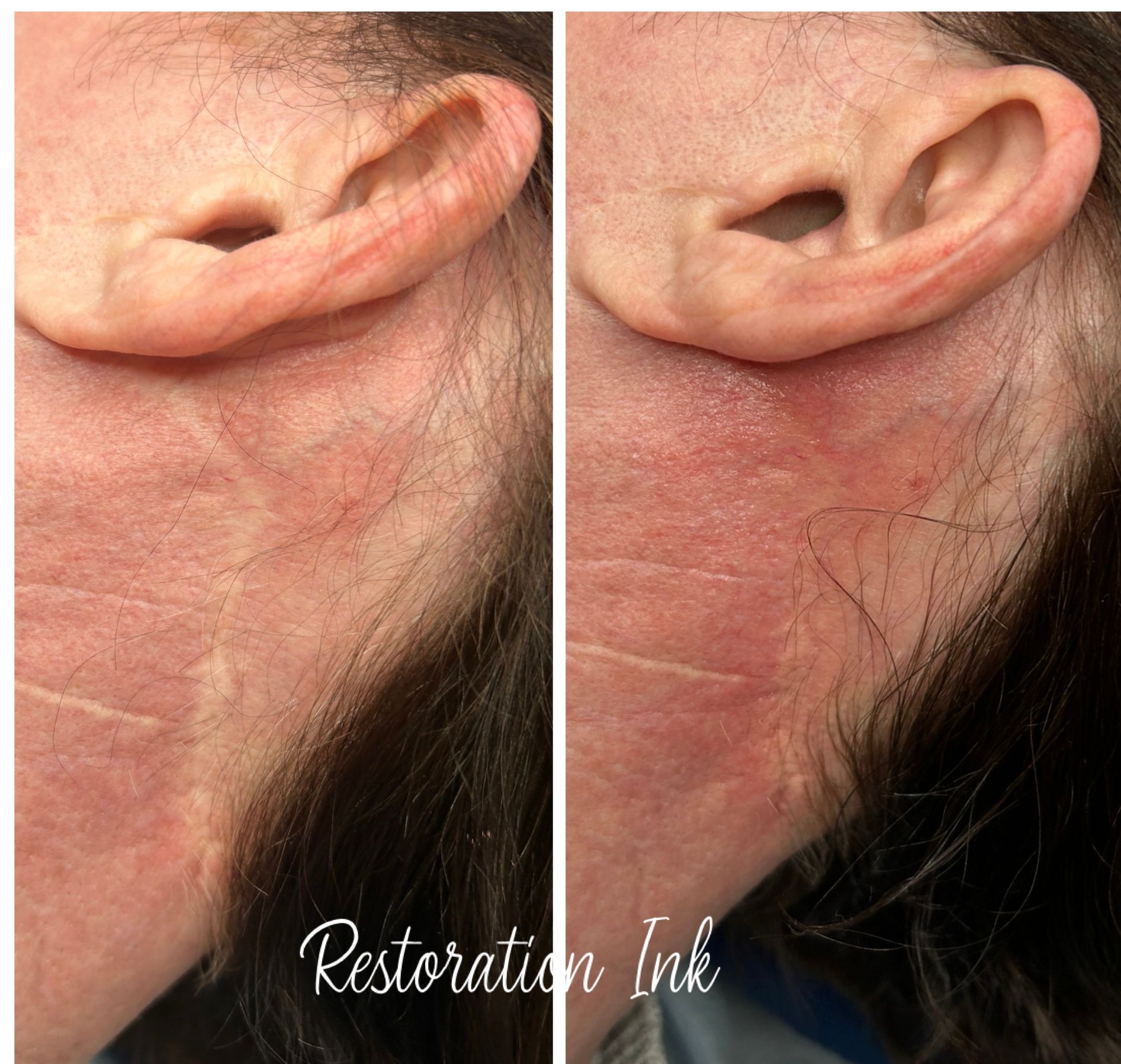 Face Lift Scar Camouflage Albuquerque, nm