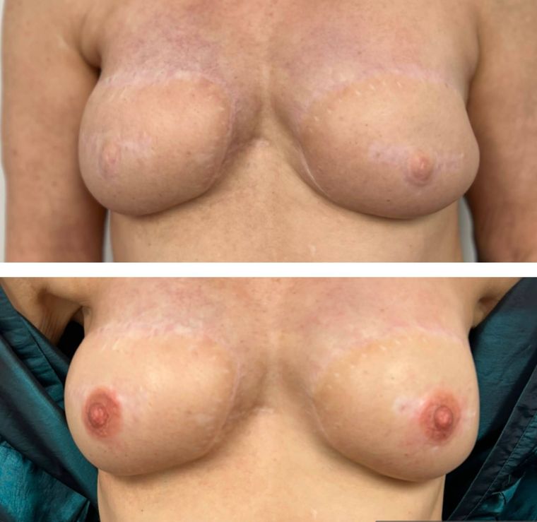 3D areola tattoos Albuquerque 