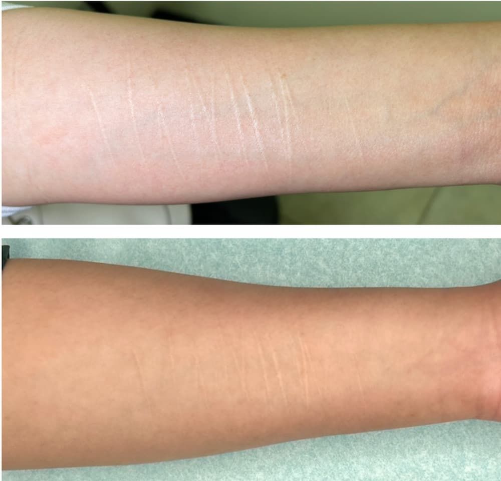 Before and after scar camouflage tattooing in Albuquerque, NM