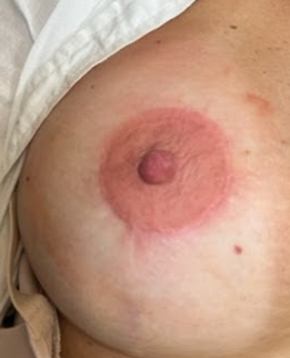 Hypopigmentation correction of the scar around the areola after breast augmentation surgery, 3D areola and nipple tattoo