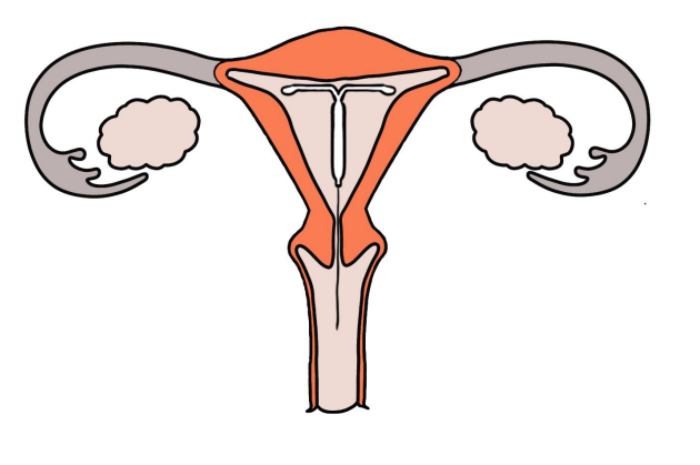 A uterus with an IUD in situ