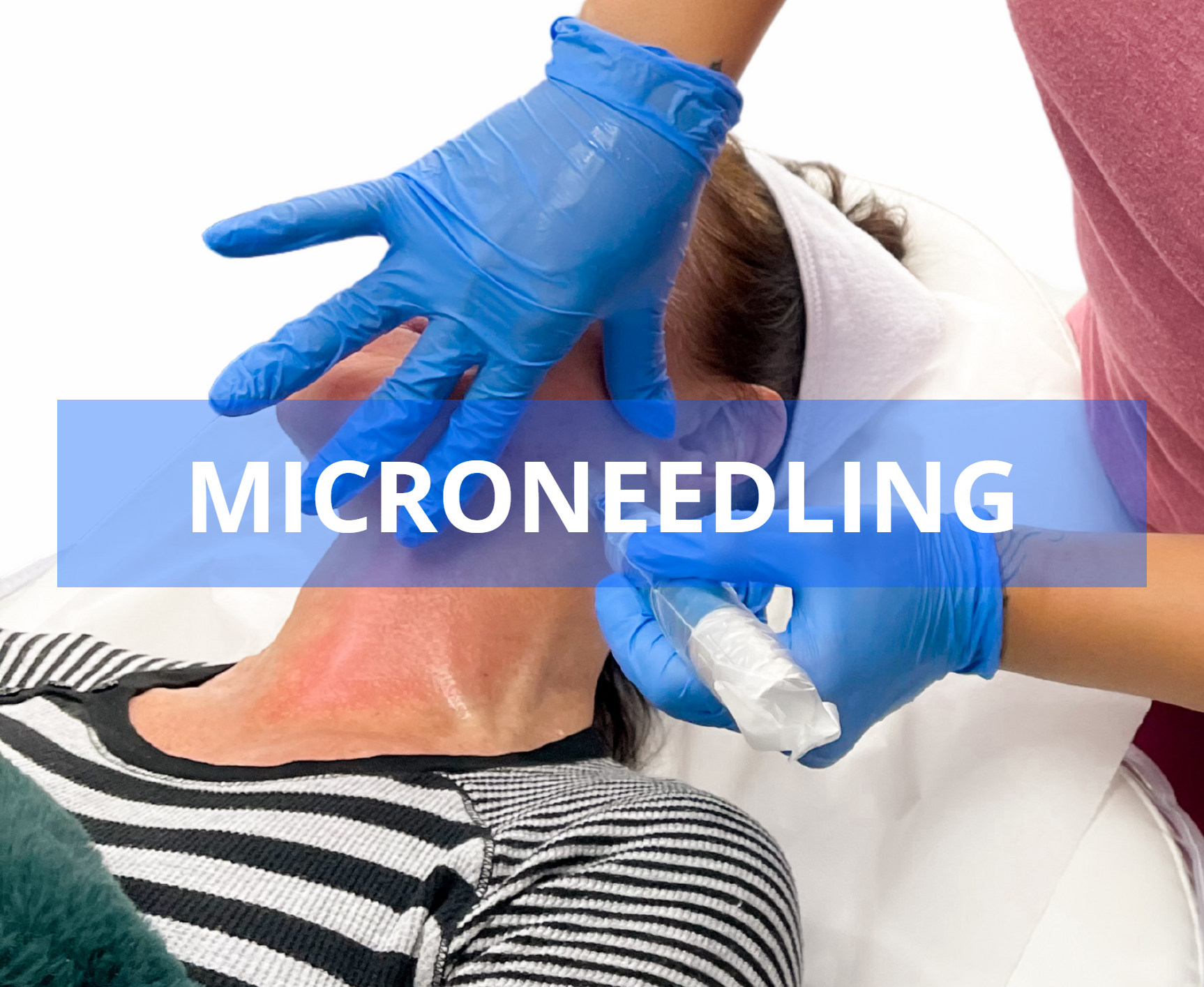 Person receiving a microneedling facial treatment. A provider wearing blue gloves applies a serum. Skin is red from the procedure.