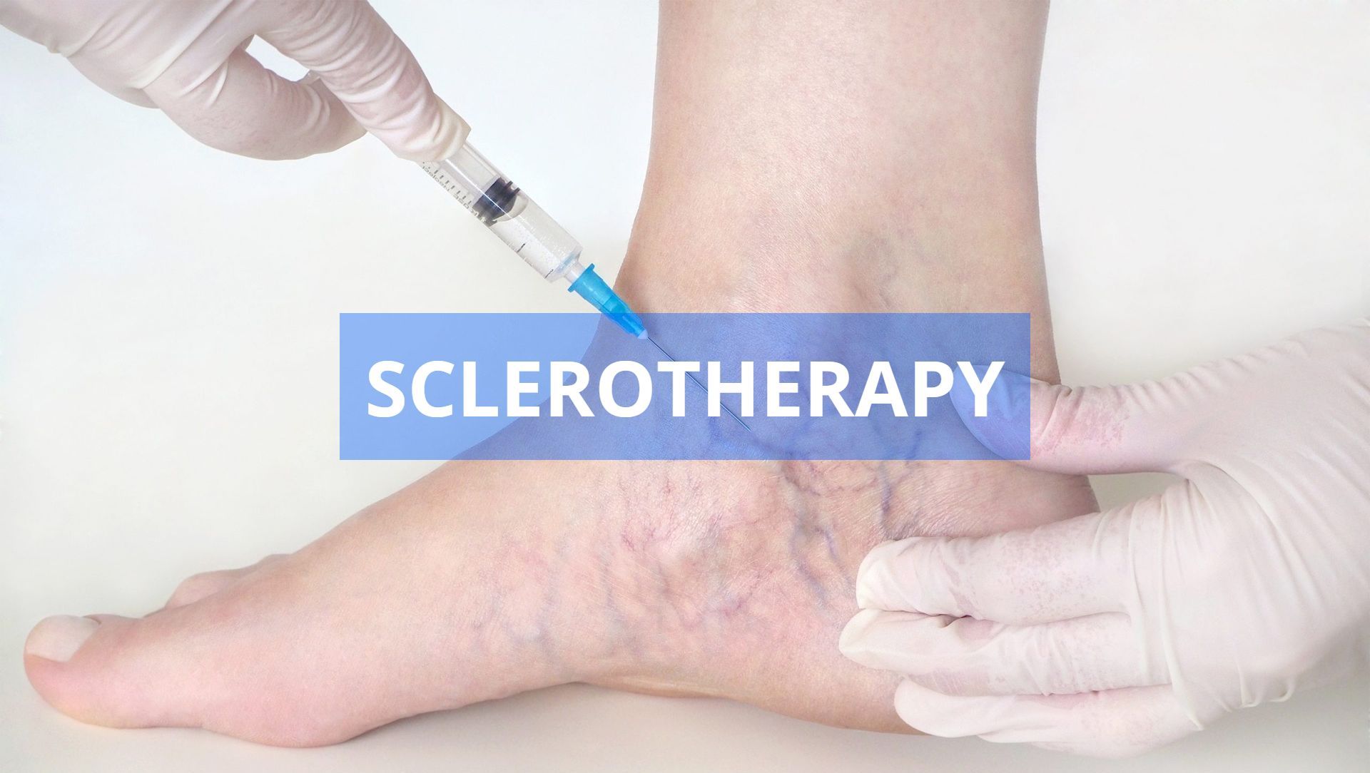 A person's foot receiving a sclerotherapy injection. The foot has visible veins, a gloved hand holds the syringe. The word 