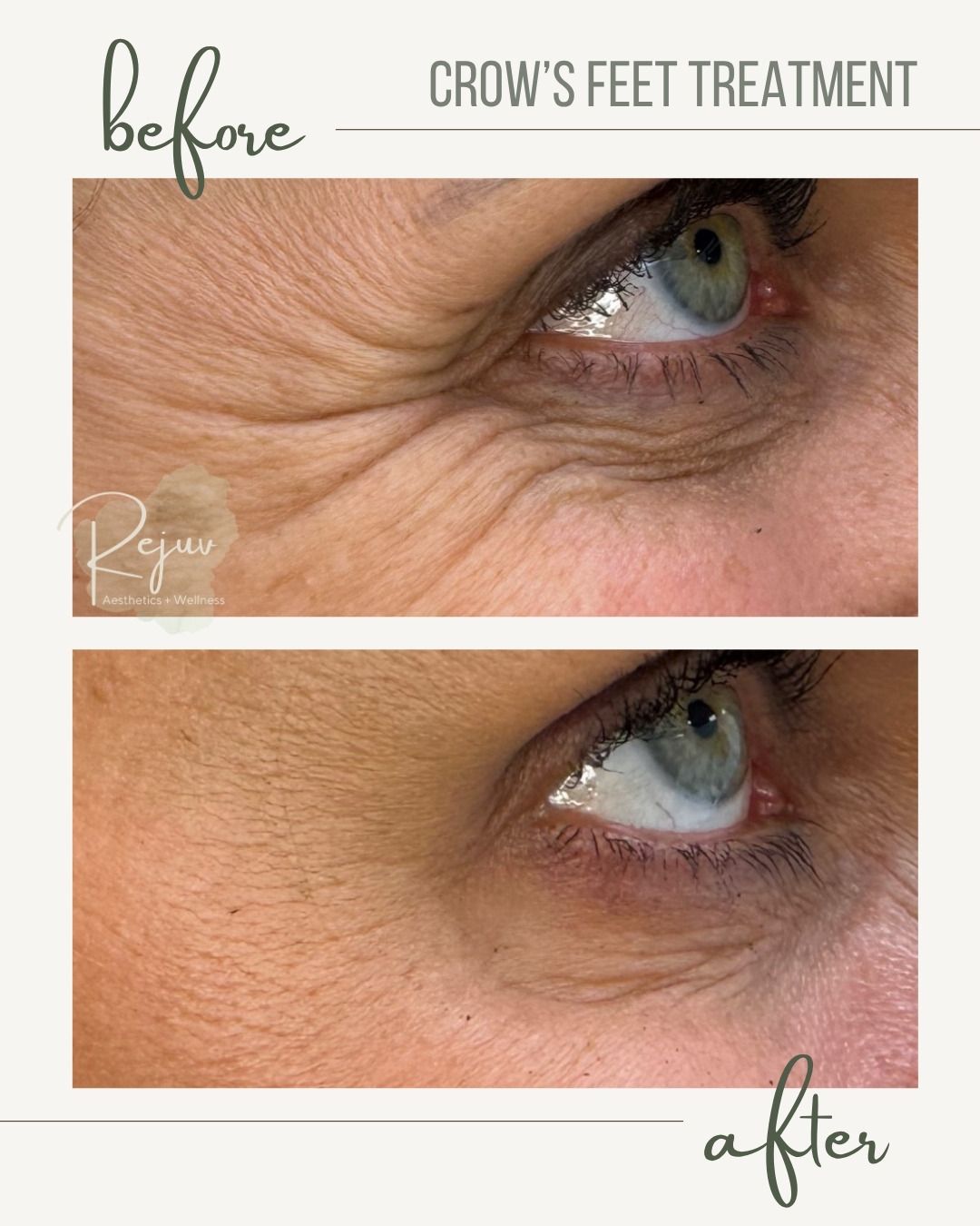Before-and-after close-up of under-eye crow’s feet treatment, showing smoother wrinkles after treatment.