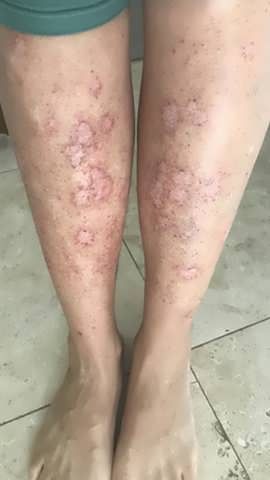 Legs with patches of red, raised, and circular skin lesions; indoor setting.