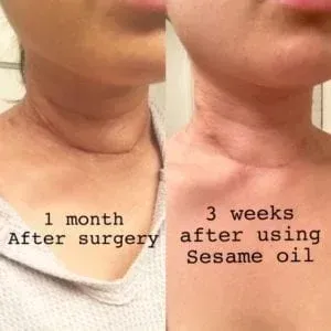 Neck comparison: post-surgery (1 month) vs. sesame oil use (3 weeks). Skin appears smoother after oil application.