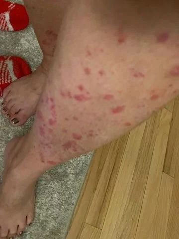 Leg with red, raised skin rash, possibly hives, indoors.
