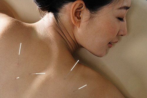 Acupuncture to Woman — Chattanooga, TN — Specialists In Pain Management