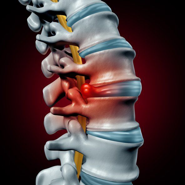Computer rendered image of a herniated disc in the spine