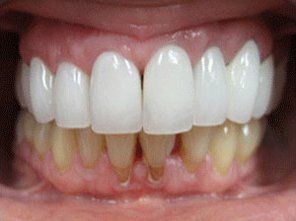 Whitened teeth — dentist in Staten Island and New York