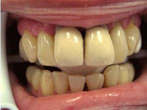Yellowish teeth — dentist in Staten Island and New York