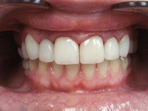 Before cosmetic — dentist in Staten Island and New York