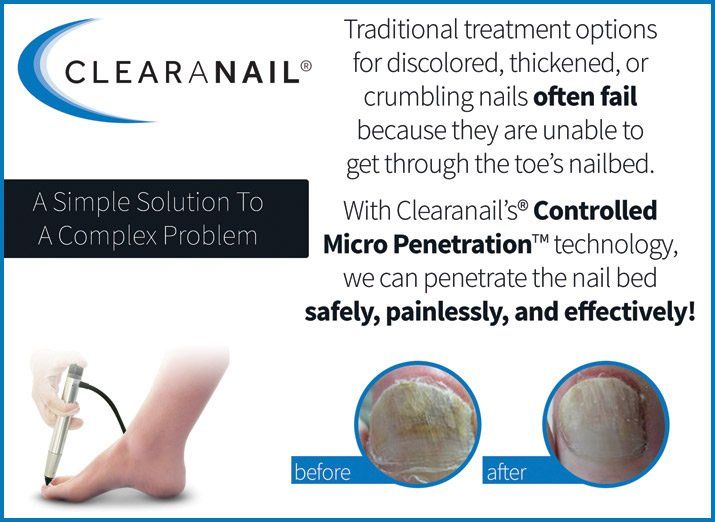 Clearanail fungal nail podiatry treatment