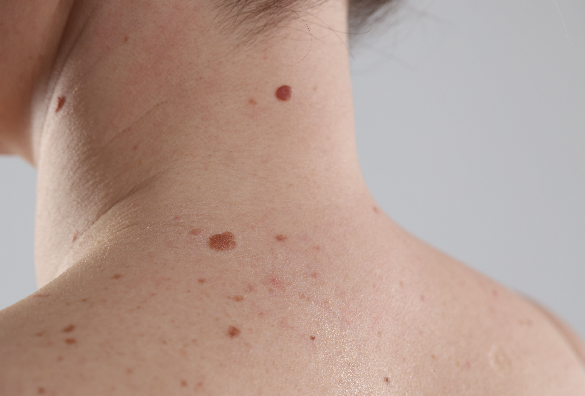 Medical professional performing eye surgery on a patient, with tools close to the closed eyelid.