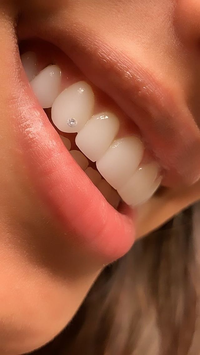 The Dangers of Tooth Gems - Stensland Dental Studio