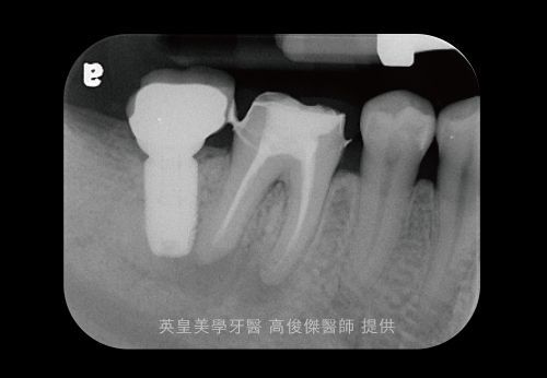 A black and white x-ray of a person 's teeth