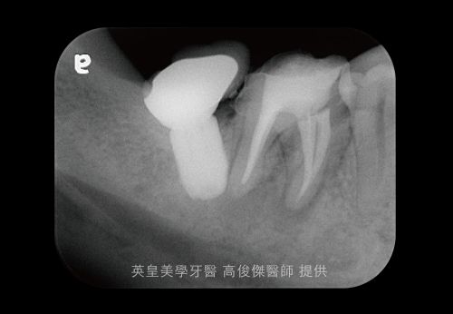 A black and white x-ray of a person 's teeth.