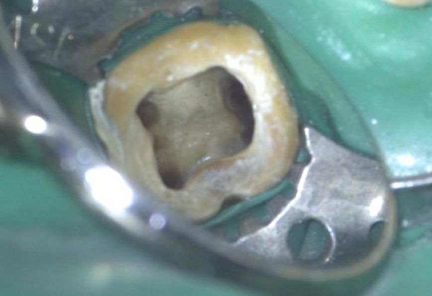 A close up of a tooth with a hole in it
