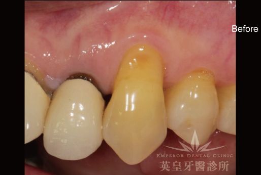 A close up of a person 's teeth with emperor dental clinic written on the bottom