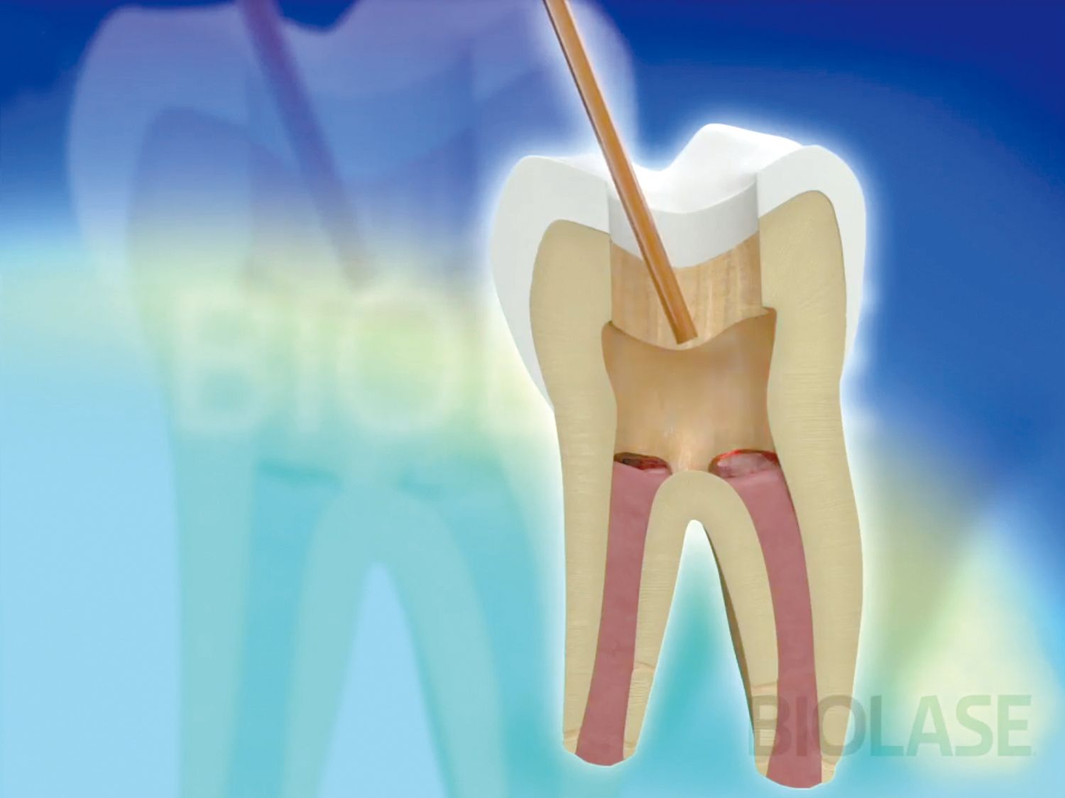A picture of a tooth with a needle sticking out of it