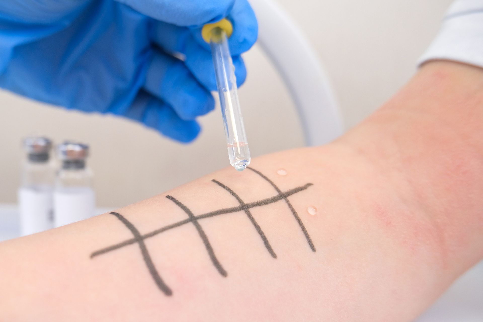 Allergy Testing — Roseville, CA — Allergy Medical Group of the North Area Inc