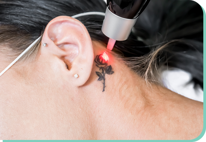 A woman is getting a tattoo removed from her neck.