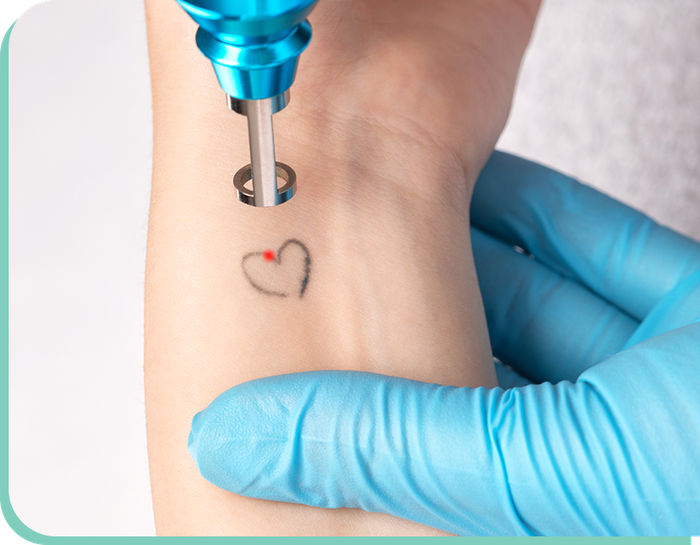 A person is getting a tattoo of a heart removed from their wrist.
