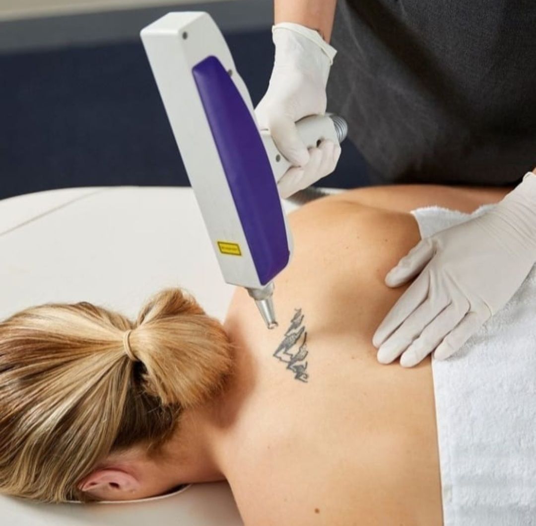 Tattoo Removal - Portland, VIC - The Beauty Boutique
