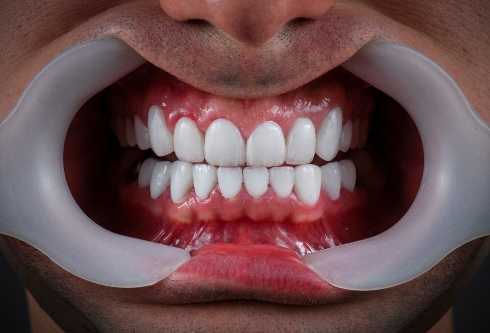 A Close Up Of A Man 's Mouth With White Teeth And A Mouth Guard — Dentures Direct Taree-Rod Hinton In Taree, NSW