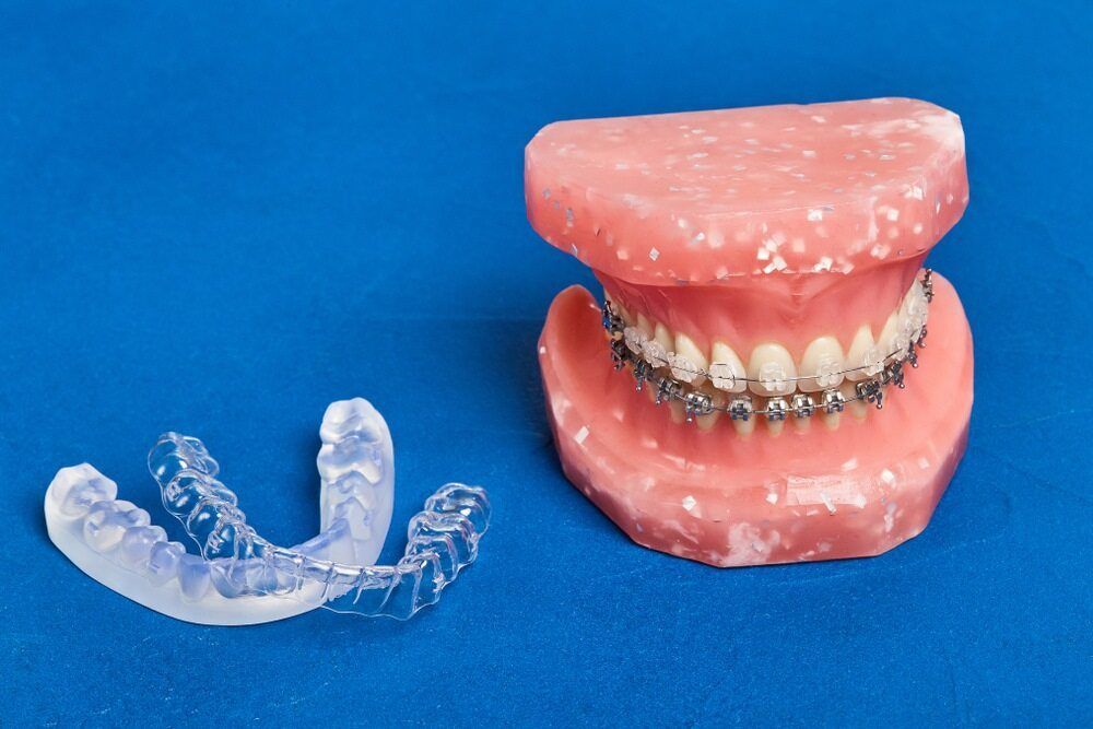 A Model Of A Mouth With Braces And A Clear Retainer — Dentures Direct Taree-Rod Hinton In Taree, NSW