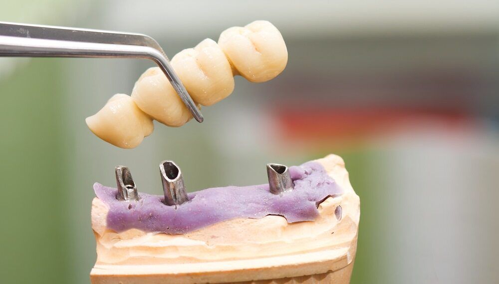 A Dental Bridge Is Being Built On A Dental Model — Dentures Direct Taree-Rod Hinton In Taree, NSW