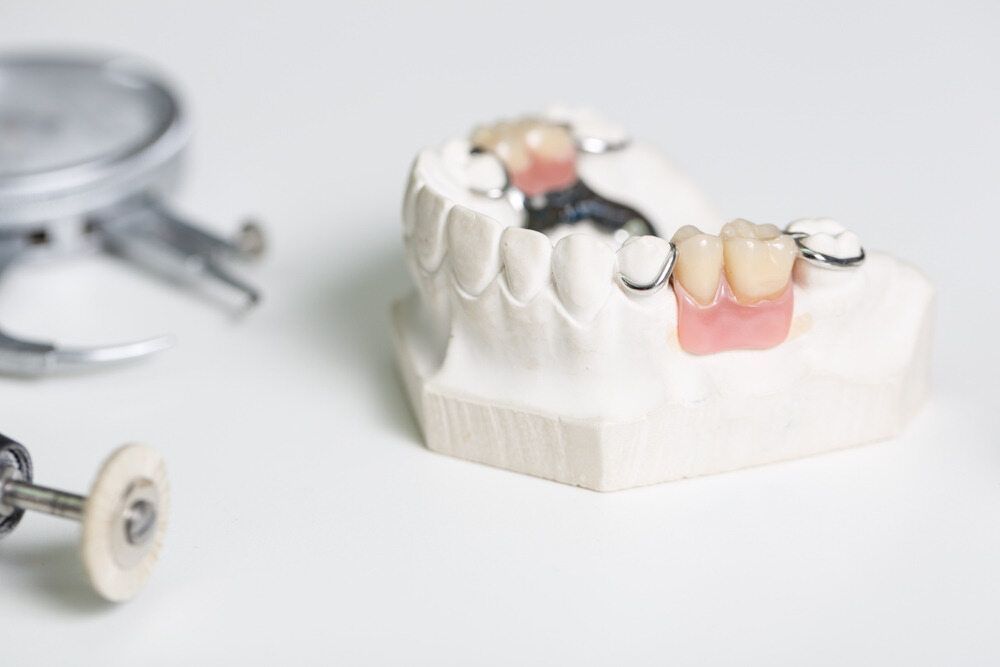 A Model Of A Tooth With A Dental Bridge On It Is Sitting On A Table — Dentures Direct Taree-Rod Hinton In Taree, NSW