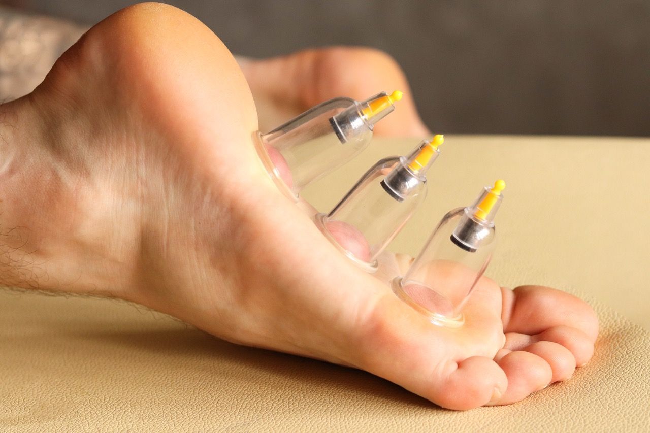 Myofascial Cupping therapy on a man's foot.