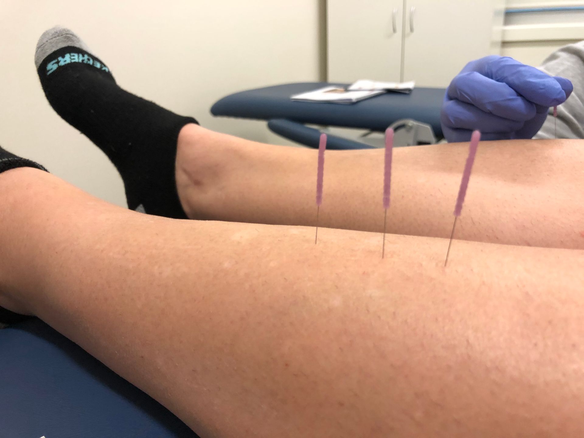 Dry needling to treat lower leg