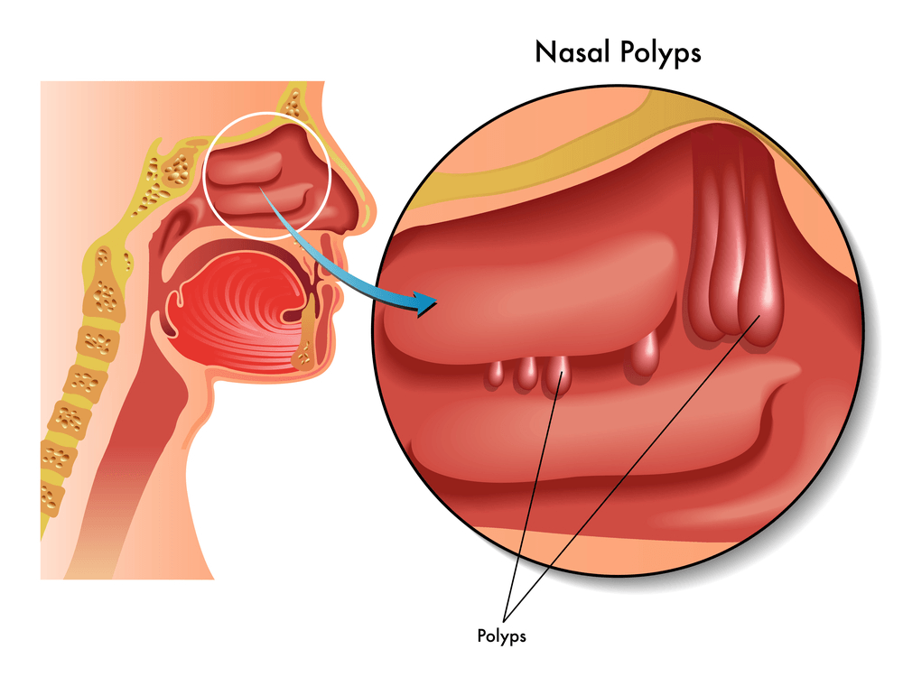 A diagram of a person 's nose and throat showing nasal polyps