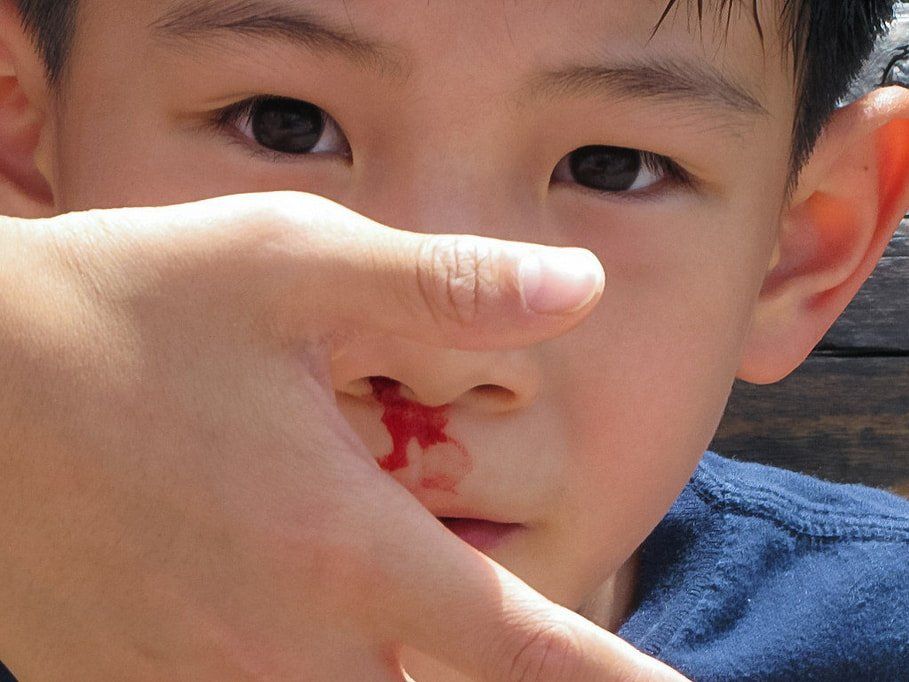 A teenage boy having a nose bleed .