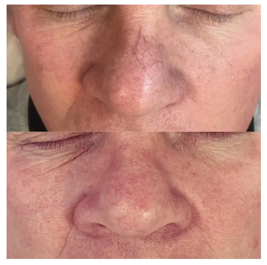 Thread Vein Removal Specialist Clinic Wetherby Revekka Treatments