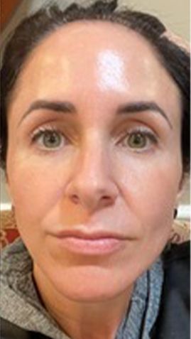 After Woman Without Makeup — Saint Johns, FL — Live Without Lines Med Spa