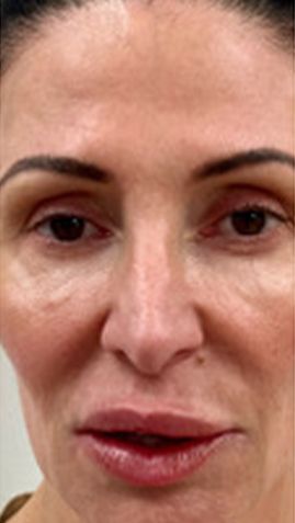 Before Woman 's Face With No Makeup on — Saint Johns, FL — Live Without Lines Med Spa